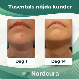 Hudfliksborttagare – Komplett kit för hemmabruk